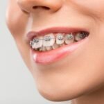 Dental implants in Matthews NC