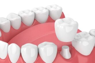 Dental Crowns in Rockville