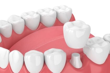 Dental Crowns in Rockville