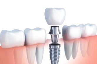 Dental Implants in Houston