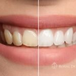 Teeth Whitening in Aurora