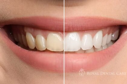 Teeth Whitening in Aurora