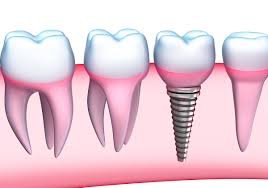 Dental Implants in Longmont