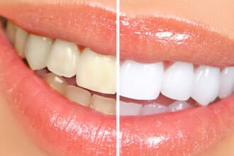 The Ultimate Guide to Teeth Whitening in Tucson, AZ