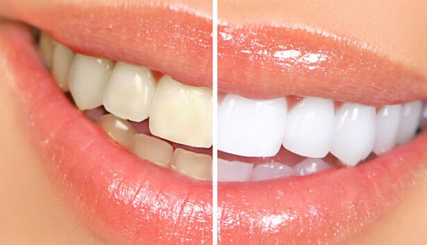 The Ultimate Guide to Teeth Whitening in Tucson, AZ