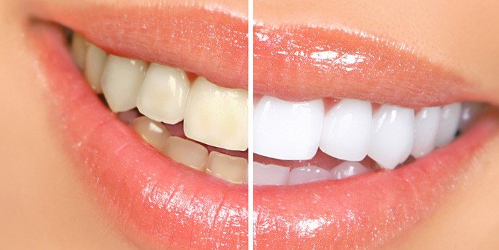 The Ultimate Guide to Teeth Whitening in Tucson, AZ